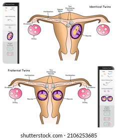 Human Twins Infographic Diagram types identical fraternal comparison chart egg sperm fertilization zygote placenta monozygotic dizygotic placentation genetic science education gene biology vector