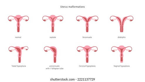 Malformaciones uterinas humanas. Conjunto de gráficos médicos.