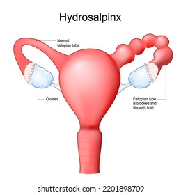 Human uterus with blocked of Fallopian tube. Hydrosalpinx cause infertility. Female reproductive system. Frontal view. Human anatomy. Realistic medical illustration. Vector poster