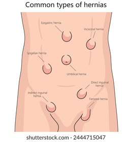 Human various hernia types on human abdomen for health and medical studies structure diagram hand drawn schematic vector illustration. Medical science educational illustration