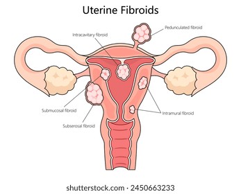 Human various types of uterine fibroids, including submucosal, subserosal, and intramural fibroids structure diagram hand drawn schematic vector illustration. Medical science educational illustration