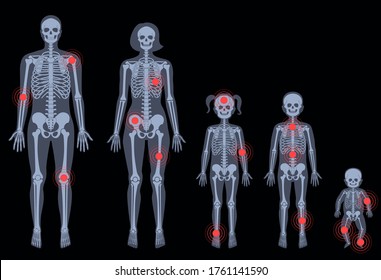 Human woman, man, boy, girl and baby skeleton pain, fracture or inflammation in front on x ray view. Vector isolated flat illustration of skull and bones in female and male body.