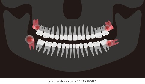 Human X-ray picture of teeth, vector illustration;, Inflamed teeth of human, It hurts in the mouth