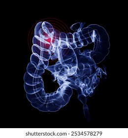 Humen colon with injury x-ray film on a dark blue background
