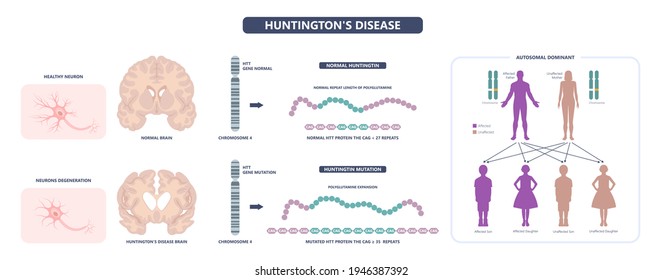 Huntington Parkinson Motor Alzheimer Neuron Brain DNA Gene Nerve Cell Juvenile Problem Defect Genetic Basal Ganglia Neuro Repeat Mutant Damage Testing Defective Mood Inherits System Family Memory Loss