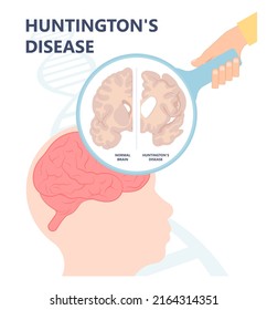 Huntington Parkinson Motor Alzheimer Neuron Brain DNA Gene Nerve Cell Juvenile Problem Defect Genetic Basal Ganglia Neuro Repeat Mutant Damage Testing Defective Mood Inherits System Family Memory Loss