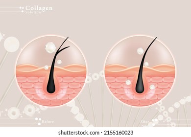 Hyaluronic acid before and after hair and skin solutions ad. White collagen serum drop over skin cells with cosmetic advertising background ready to use, illustration vector.	