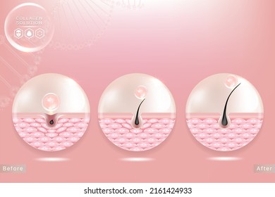 Hyaluronic acid before and after hair and skin solutions ad. pink collagen serum drop over skin cells with cosmetic advertising background ready to use, illustration vector.