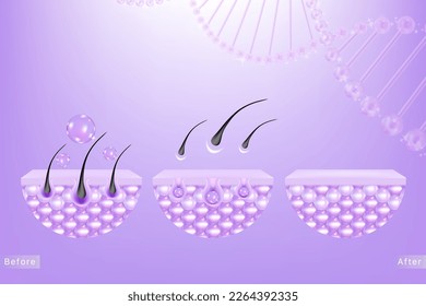 Hyaluronsäure vor und nach Haar- und Hautlösungen und, violetter Serumabfall in Hautzellen mit kosmetischen, gebrauchsfertigen Werbehintergrund, Vektorgrafik.	