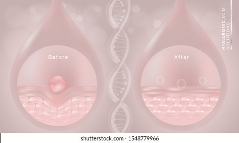 Hyaluronic acid before and after skin solutions ad, pink collagen serum drop with cosmetic advertising background ready to use, illustration vector.	
