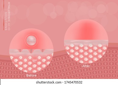 Hyaluronic acid before and after skin solutions ad, pink collagen serum drop with cosmetic advertising background ready to use, illustration vector.	