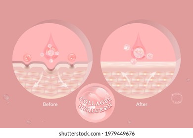 Hyaluronic acid before and after skin solutions ad, pink collagen serum drops with cosmetic advertising background ready to use, illustration vector.	