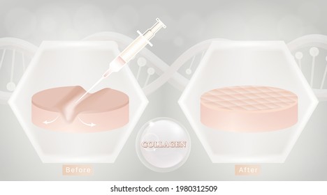 Hyaluronic acid before and after skin solutions ad, white collagen injection with cosmetic advertising background ready to use, illustration vector.