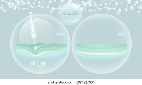 Hyaluronic acid before and after skin solutions ad, blue collagen injection with cosmetic advertising background ready to use, illustration vector.