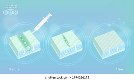 Hyaluronic acid before and after skin solutions ad, blue collagen injection with cosmetic advertising background ready to use, illustration vector.