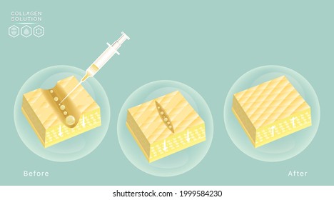 Hyaluronic acid before and after skin solutions ad, gold collagen injection, cosmetic advertising background ready to use, illustration vector.