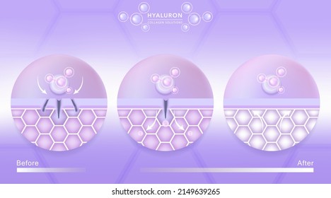 Hyaluronsäure vor und nach Hautlösungen fällt violettes Kollagen-Serum über Hautzellen mit kosmetischen, gebrauchsfertigen Werbetafeln, Vektorgrafik.