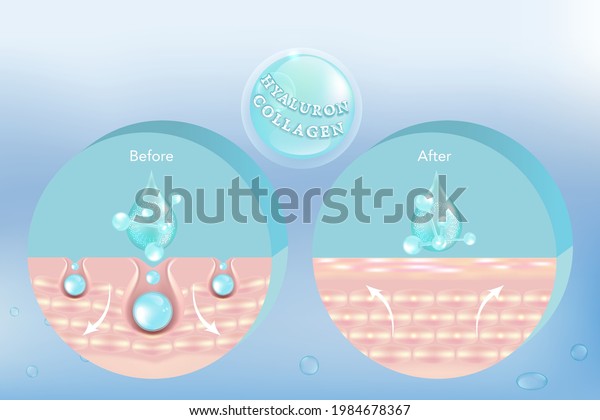 Hyaluronic Acid Before After Skin Solutions Stock Vector (Royalty Free ...