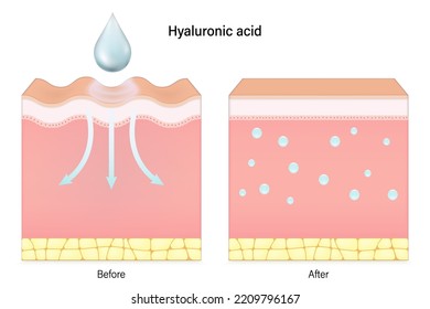 Hyaluronic acid. Comparison of skin before and after hyaluronic acid use. Vector for advertising about beauty and medical treatment.