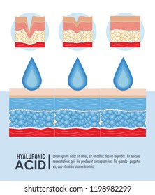 hyaluronic acid filler injection infographic