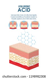 hyaluronic acid filler injection infographic