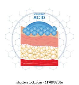 hyaluronic acid filler injection infographic