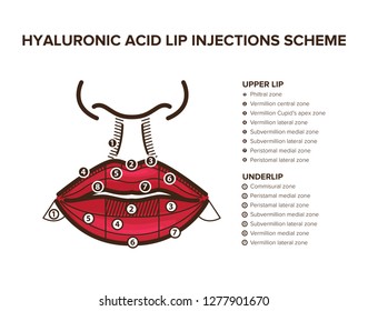 Hyaluronic acid filler. Lip injections. Lip anatomy. Illustration for your design