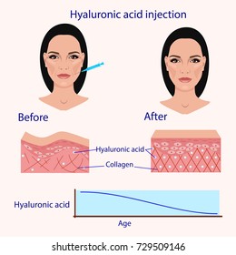 hyaluronic acid injection, before and after , vector illustration, diagram