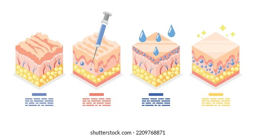 Composición isométrica del ácido alurónico con un conjunto de cubos que representan la estructura de la piel antes y después de la rejuvenecimiento de la ilustración vectorial de la inyección