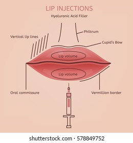 Hyaluronic acid lip injections scheme. Vector illustration with detailed anatomical zones infographic in pink and brown colours. Medical, cosmetological and anti-aging concept.