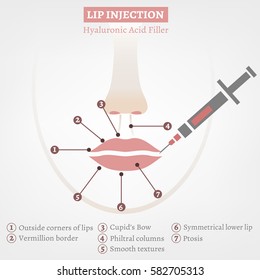 Hyaluronic acid lip injections scheme in iconic style. Vector illustration with detailed anatomical zones infographic in pink and white colours. Medical, cosmetological and anti-aging concept.