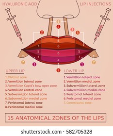 Hyaluronic acid lip injections scheme. Vector illustration with detailed anatomical zones infographic in pink and brown colours. Medical, cosmetological and anti-aging concept.