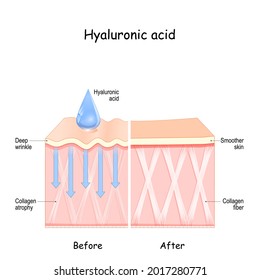 Hyaluronic acid. skin Before and After Hyaluronic acid use. comparison and difference between skin with  Collagen atrophy and Deep wrinkles and  Smoother skin after cosmetic procedure