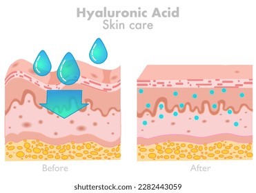 Hyaluronic acid, skin care. Before after products. HA absorb, rejuvenation wrinkles. Human facial fillers. Water moisturizer. Dermatology, humectant, skincare, anti aging. Illustration vector