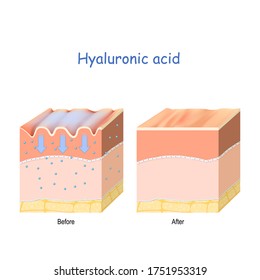 Hyaluronic acid. skin rejuvenation with help of skin-care products.  wrinkles on the human skin. Before and after use of the hyaluronic acid 