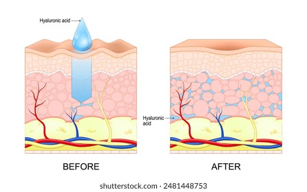 Hyaluronic acid. Skin rejuvenation. Wrinkles Before and after hyaluronic acid use. Vector illustration