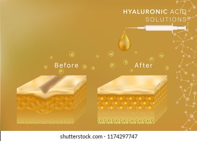 Hyaluronic acid skin solutions ad, gold collagen serum drop with cosmetic advertising background ready to use, syringe in 3d illustration.