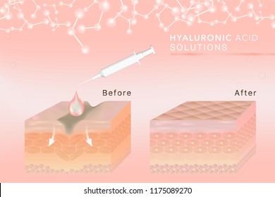 Hyaluronic acid skin solutions ad, pink collagen serum drop with cosmetic advertising background ready to use, syringe in 3d illustration.