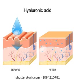 Hyaluronic acid. skin-care products. skin rejuvenation with help of hyaluronic acid