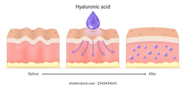 Hyaluronic acid vector. Comparison of skin before and after hyaluronic acid use. Vector for advertising about beauty and medical treatment.