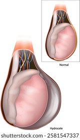 Hydrocele testis. Accumulation of serous fluid in a body cavity. Tunica vaginalis. Testis Anatomy Medical Illustration. Male Reproductive System Cross-Section