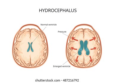 Hydrocephalus 