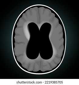 Hydrocephalus. Accumulation Of Excess Cerebrospinal Fluid In The Ventricles Of The Brain. Vector Illustration