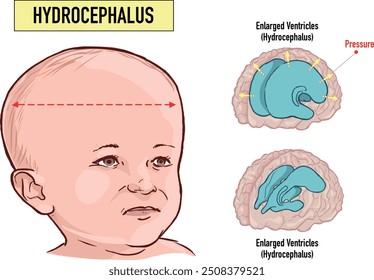 Hydrocephalus brain cerebrospinal fluid (CSF) drain head spina autism cerebral palsy myelomeningocele baby obstructive pediatric neurology birth defects