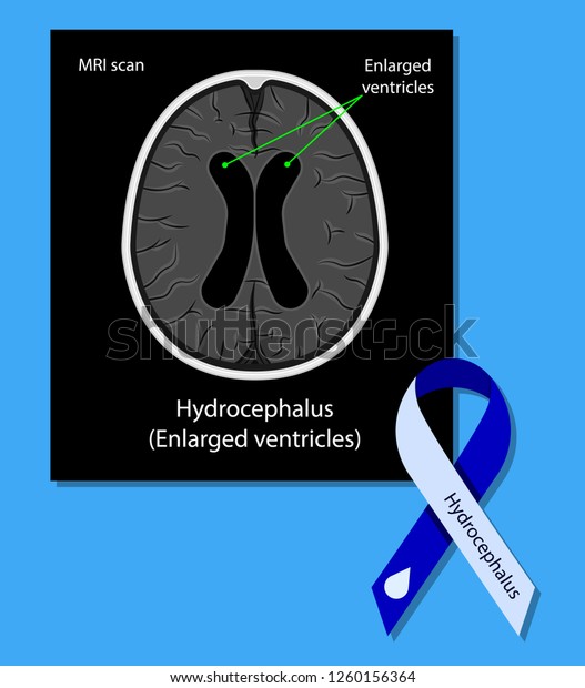 Hydrocephalus Brain Cerebrospinal Fluid Csf Drain Stock Vector Royalty Free 1260156364 2524