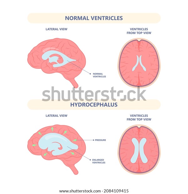 Hydrocephalus brain cerebrospinal fluid (CSF)\
drain head spina autism cerebral palsy myelomeningocele baby\
obstructive pediatric neurology birth\
defects