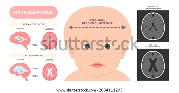 Hydrocephalus brain cerebrospinal fluid (CSF)\
drain head spina autism cerebral palsy myelomeningocele baby\
obstructive pediatric neurology birth\
defects