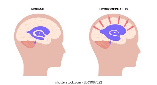 Hydrocephalus Shunt In The Child Head Poster. Pressure On The Brain. Ventricular System Anatomy. Cerebral Ventricles, Cerebrospinal Fluid In Kid Silhouette. Medical Flat Vector Illustration.