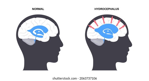 Hydrocephalus Shunt Concept. Pressure On The Brain Poster. Ventricular System Anatomy. Cerebral Ventricles, Production, Transport And Removal Of Cerebrospinal Fluid. Medical Flat Vector Illustration.