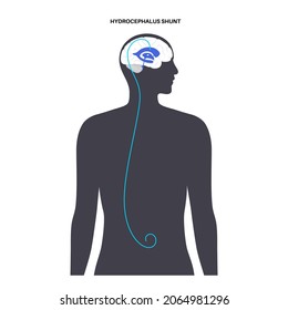 Hydrocephalus shunt concept. Pressure on the brain poster. Ventricular system anatomy. Cerebral ventricles, production, transport and removal of cerebrospinal fluid. Medical flat vector illustration.